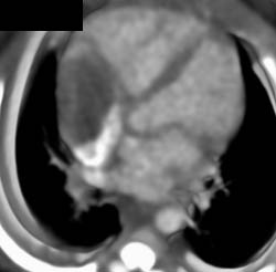 Clot in Left Atrium ???? - CTisus CT Scan