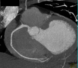 Normal RCA With Plaque LAD - CTisus CT Scan