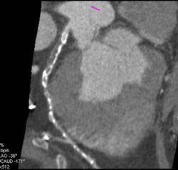 LAD With Proximal Critical Stenosis - CTisus CT Scan