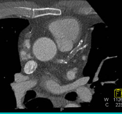 LAD Occlusion - CTisus CT Scan