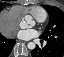 Bicuspid Valve - CTisus CT Scan