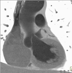 Bicuspid Valve With Valve Calcification - CTisus CT Scan