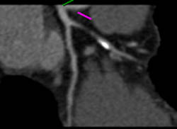 LAD Disease - CTisus CT Scan