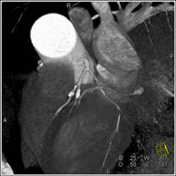 LAD Disease - CTisus CT Scan