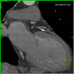 LAD Disease - CTisus CT Scan