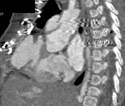 Pseudoaneurysm Projected Anteriorly - CTisus CT Scan