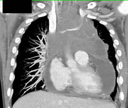 Huge Pericardial Effusion and Tumor Infiltration of Pericardium - CTisus CT Scan