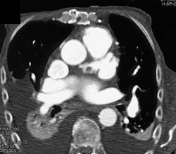 Atrial Appendage Thrombus - CTisus CT Scan