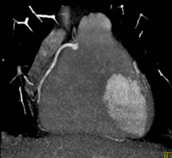 Normal RCA and LAD Disease - CTisus CT Scan