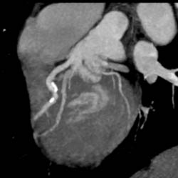 LAD Disease - CTisus CT Scan