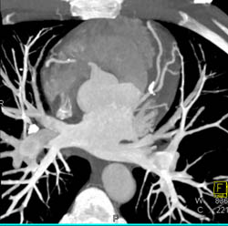 LAD Disease - CTisus CT Scan