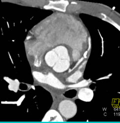 LAD Disease - CTisus CT Scan