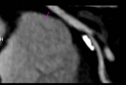 Eccentric Plaque With LAD Stenosis - CTisus CT Scan