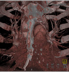 Bypass Grafts - CTisus CT Scan