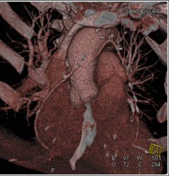 Bypass Grafts - CTisus CT Scan