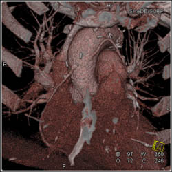 Bypass Grafts - CTisus CT Scan