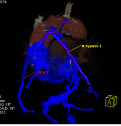 Bypass Grafts - CTisus CT Scan