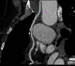 Bypass Grafts - CTisus CT Scan