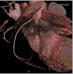 Normal RCA Which Is A Dominant Circulation Pattern - CTisus CT Scan