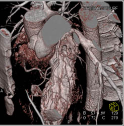 LAD Disease - CTisus CT Scan