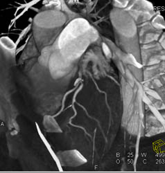 LAD Disease - CTisus CT Scan