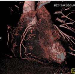 Normal RCA - CTisus CT Scan