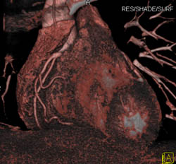 Normal RCA - CTisus CT Scan