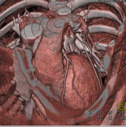 Normal LAD - CTisus CT Scan