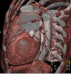 Normal LAD - CTisus CT Scan