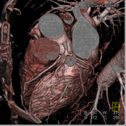 Normal LAD - Cardiac Case Studies - CTisus CT Scanning