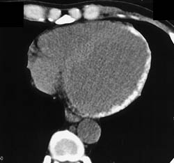 Myocardial Calcification- Renal Dysfunction - CTisus CT Scan