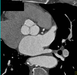 Normal Aortic Valve - CTisus CT Scan