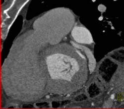 Normal Aortic Valve - CTisus CT Scan