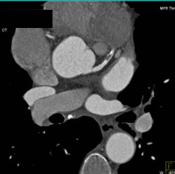 Normal Aortic Valve - CTisus CT Scan