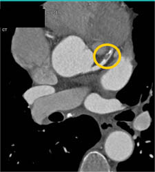 Plaque LAD With Greater Than 50% Stenosis - CTisus CT Scan