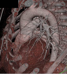 Normal LAD - CTisus CT Scan