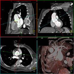 Normal LAD - CTisus CT Scan