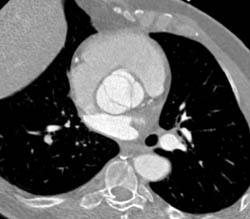 Bicuspid Valve - CTisus CT Scan