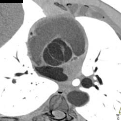 Bicuspid Valve - CTisus CT Scan