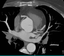 Sa Nodal Artery Off RCA - CTisus CT Scan