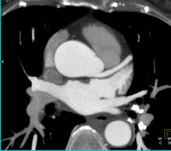 Normal LAD - CTisus CT Scan