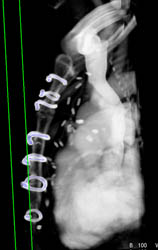 S/P Median Sternotomy - CTisus CT Scan