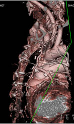 Bypass Grafts - CTisus CT Scan