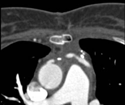 Bypass Grafts - CTisus CT Scan