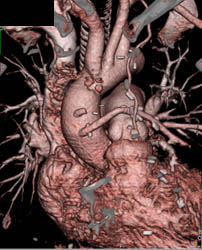 Bypass Grafts - CTisus CT Scan