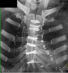 Normal Post-op Sternum S/P Bypass - CTisus CT Scan