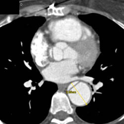 Type A Dissection - CTisus CT Scan