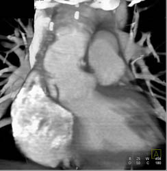 Type A Dissection - CTisus CT Scan