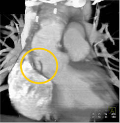 Type A Dissection - CTisus CT Scan