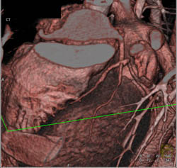 Post Op Aortic Root Repair - CTisus CT Scan